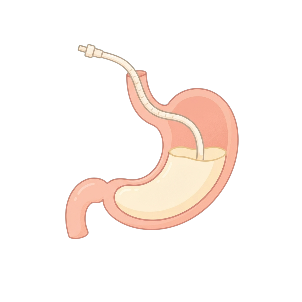 Illustration of a stomach with a nasogastric tube inserted for feeding purposes